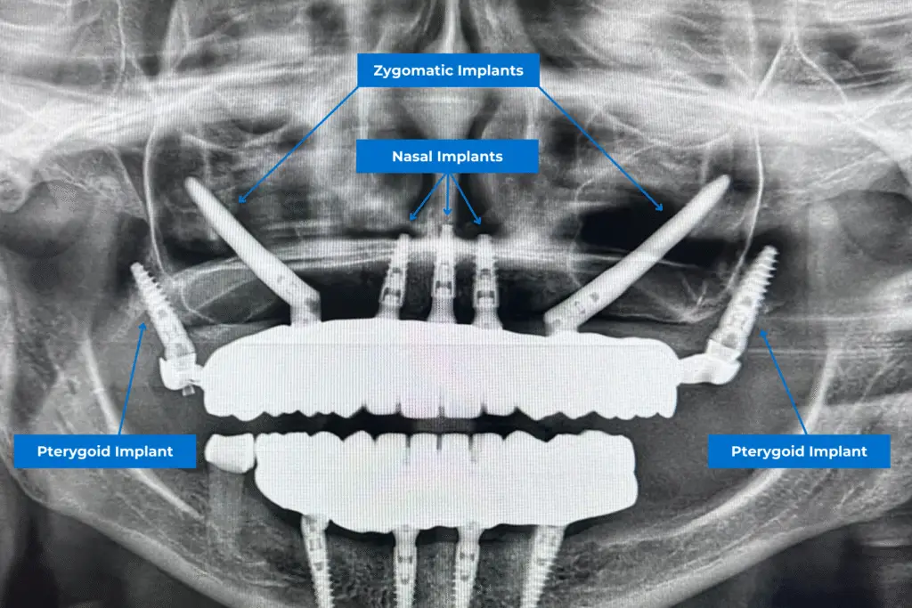 different types of dental implants: nasal implants, zygomatic implants and pterygoid implants