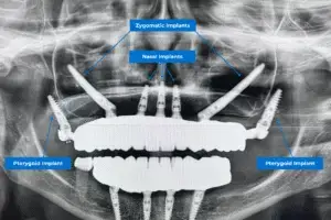 different types of dental implants: nasal implants, zygomatic implants and pterygoid implants