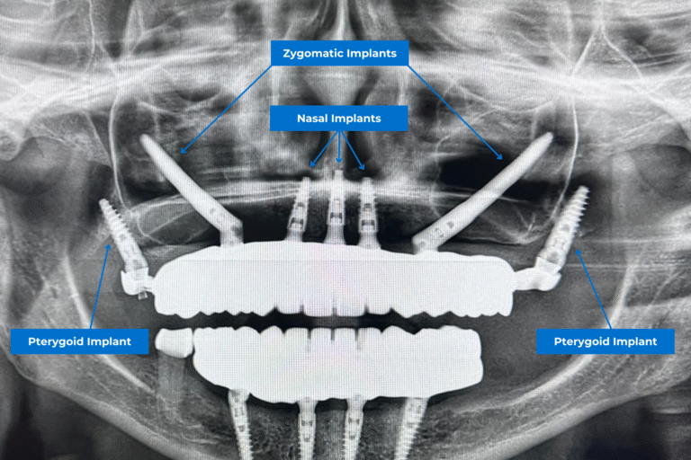 diversi tipi di impianti dentali: impianti nasali, impianti zigomatici e impianti pterigoidei