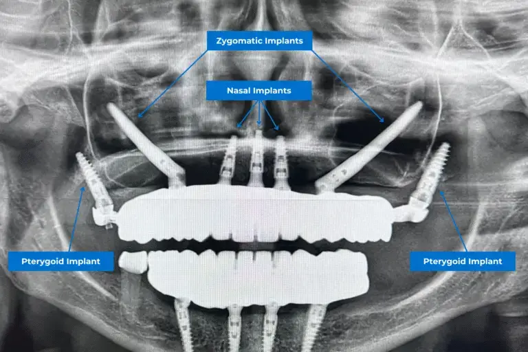 different types of dental implants: nasal implants, zygomatic implants and pterygoid implants