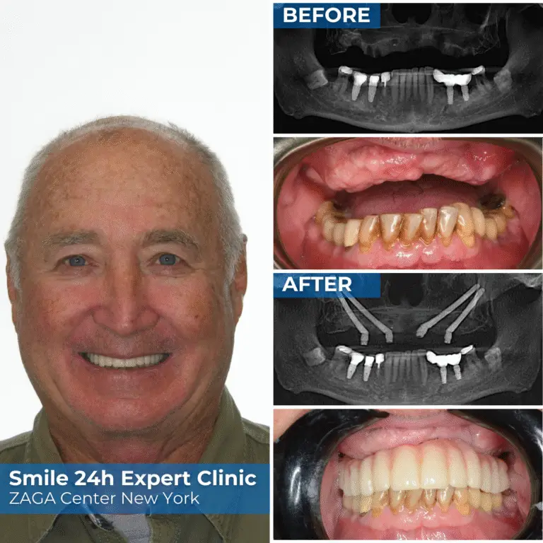 Bruce Colleman personal story - dental implants before and after