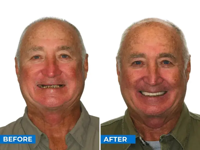 Bruce Colleman personal story - dental implants before and after