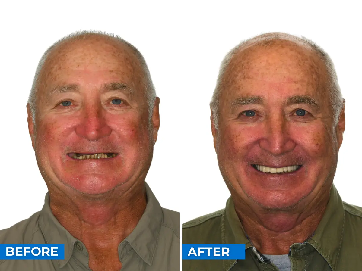 Bruce Colleman personal story - dental implants before and after
