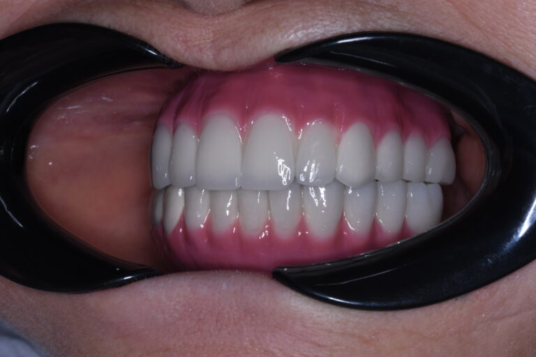 Meleki lõpliku proteesi pilt