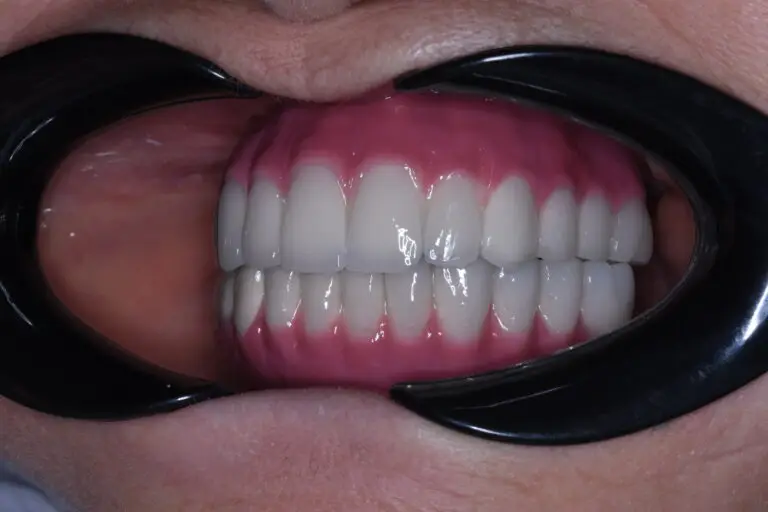 Melek's definitive prosthesis picture