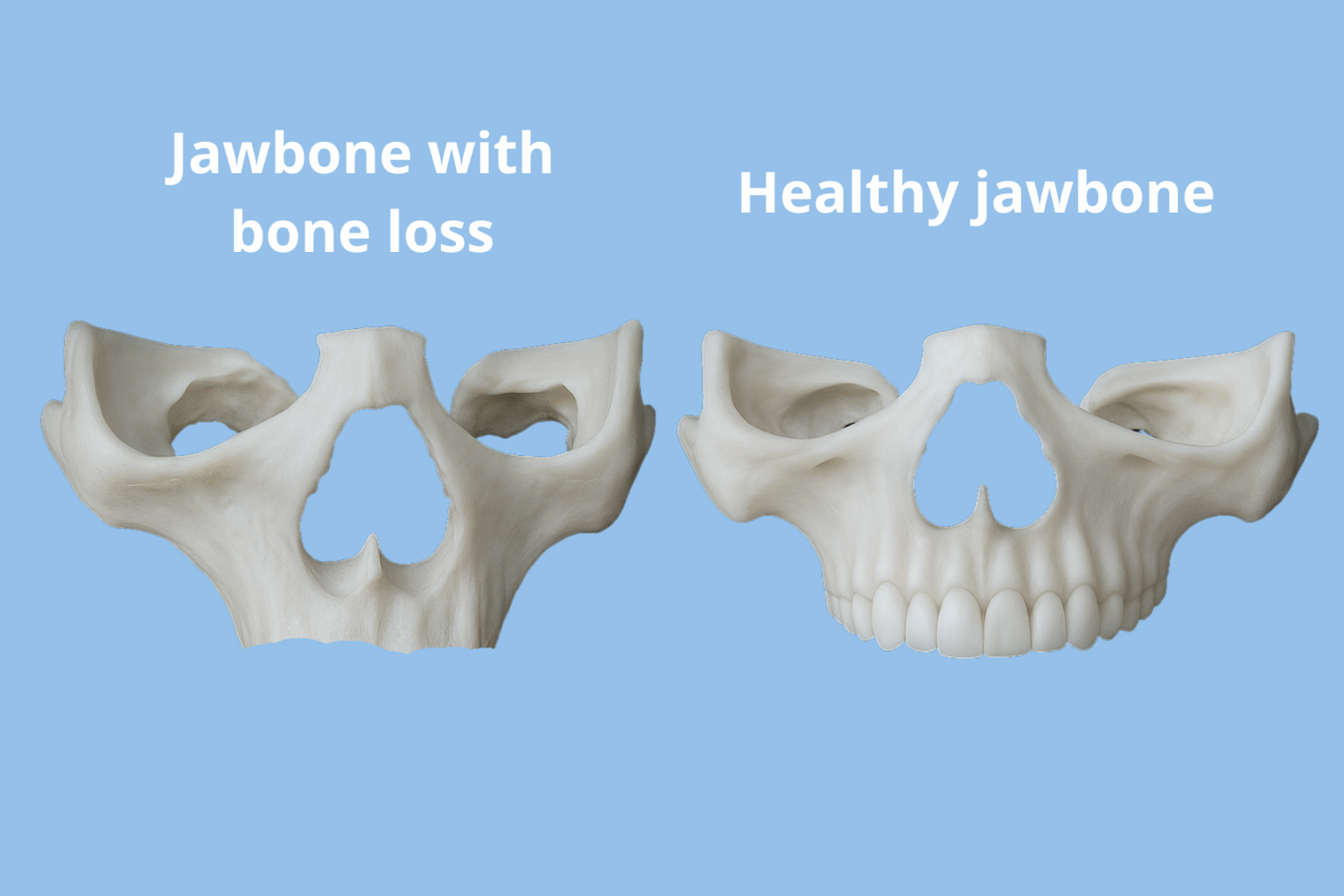 Dental 3D models representing an atrophic maxilla vs a healthy jawbone