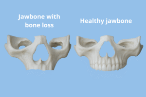 Dental 3D models representing an atrophic maxilla vs a healthy jawbone