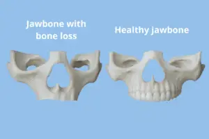 Dental 3D models representing an atrophic maxilla vs a healthy jawbone