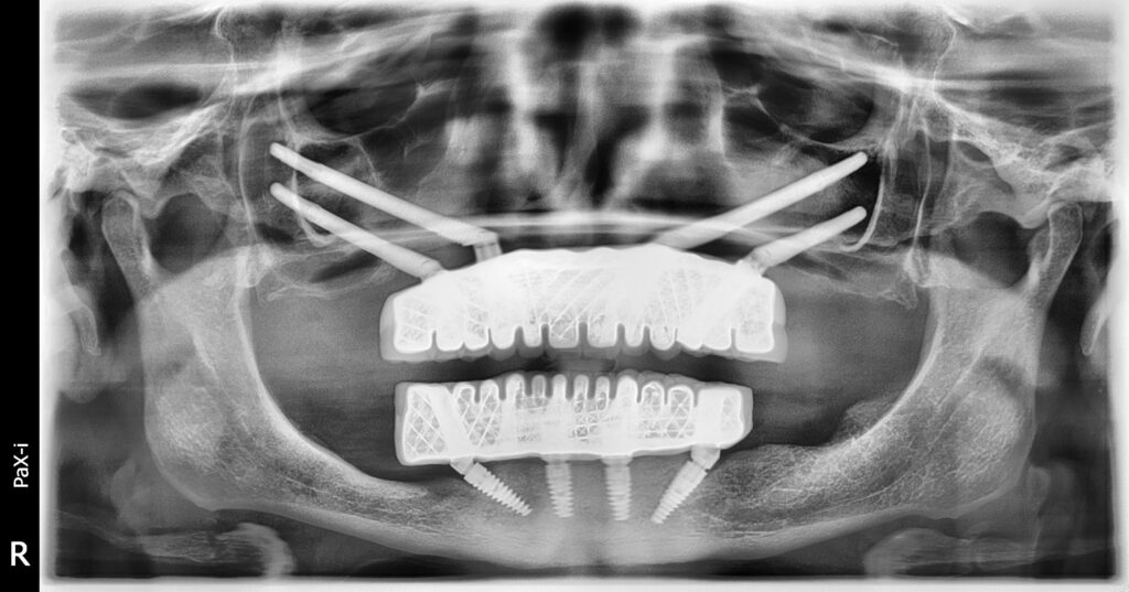 Melek's scan after placing dental implants