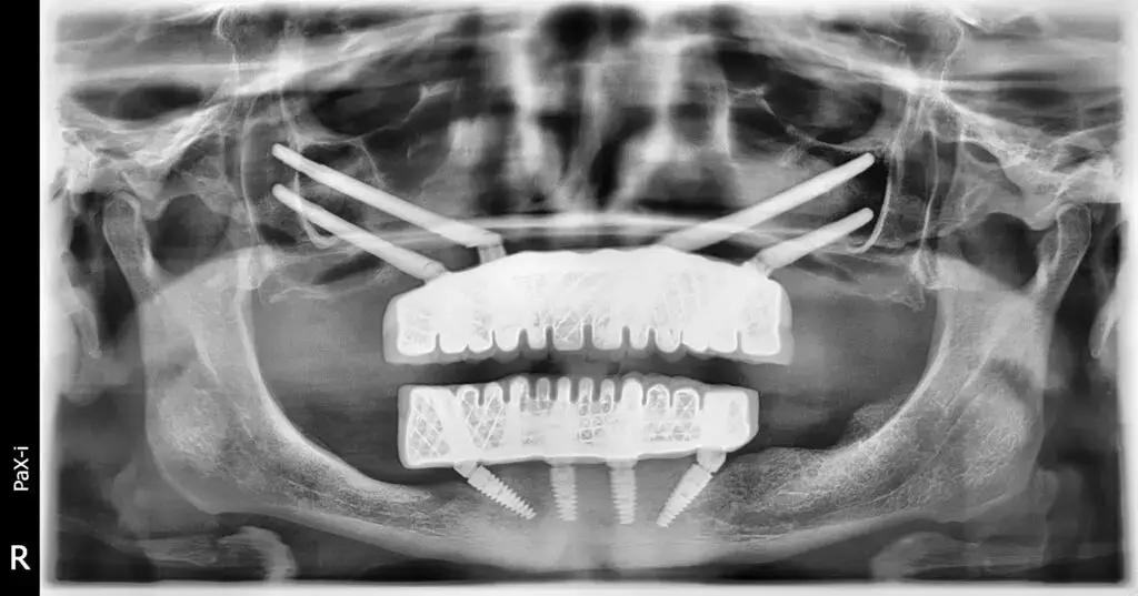 Melek's scan after placing dental implants