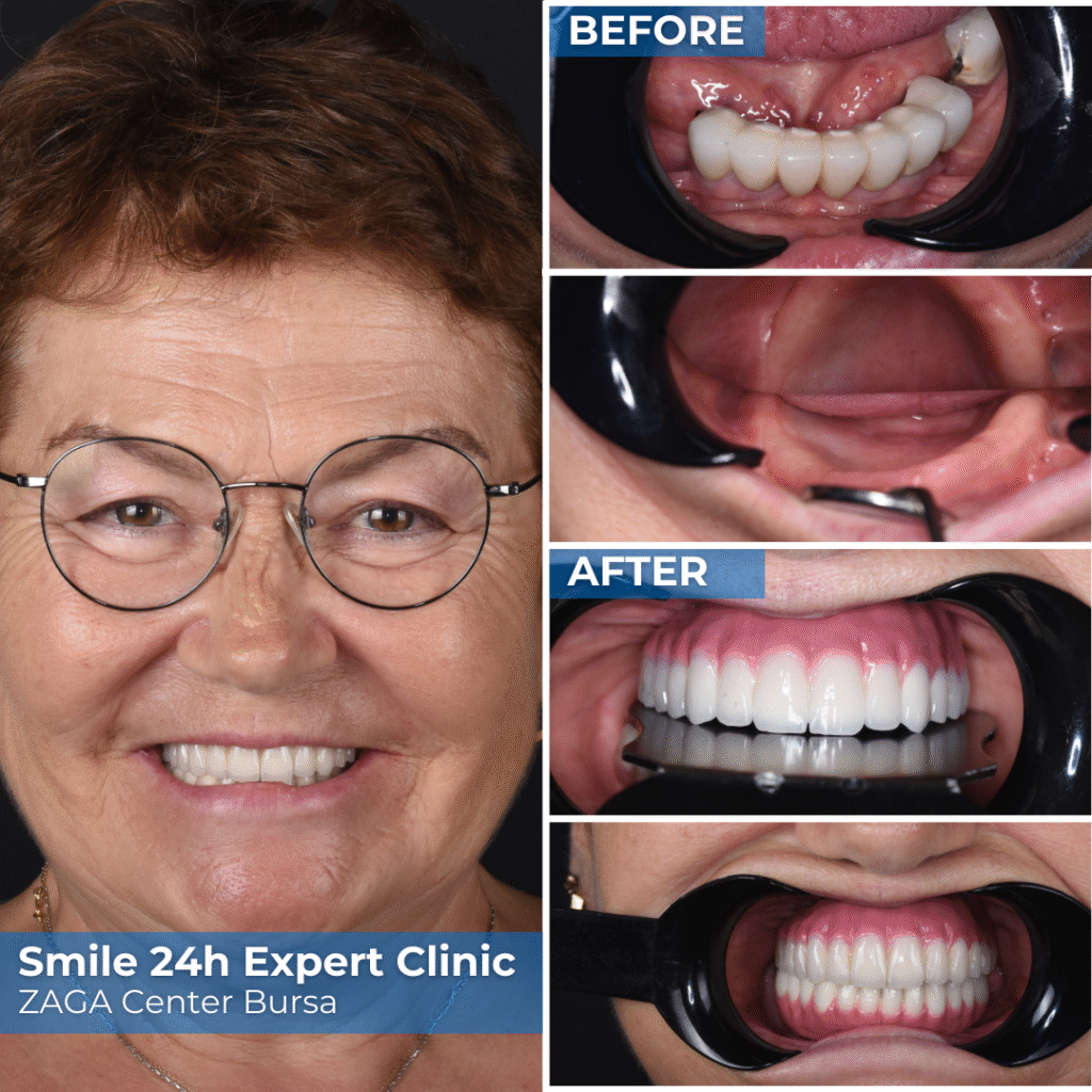 Patient Success Stories: Melek - ZAGA Center Bursa