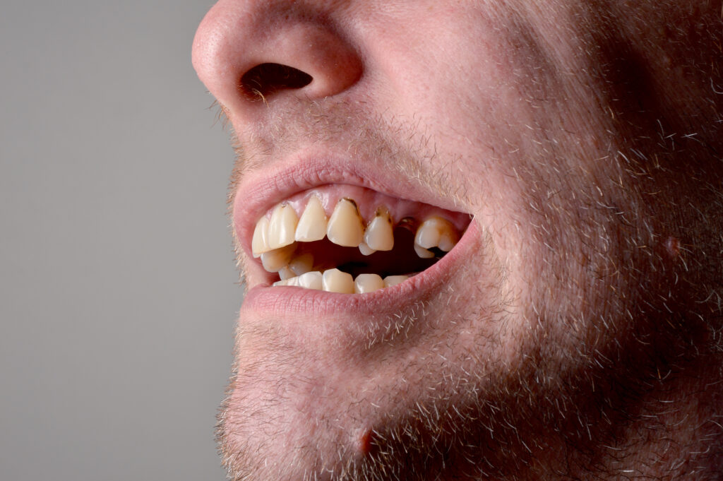 Man showing missing teeth, which provoques bone loss