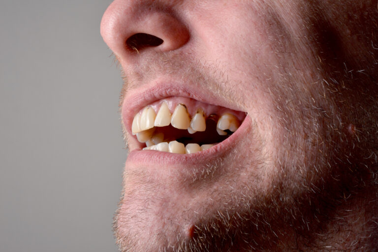 歯の欠損を示す男性、これは骨欠損を引き起こす