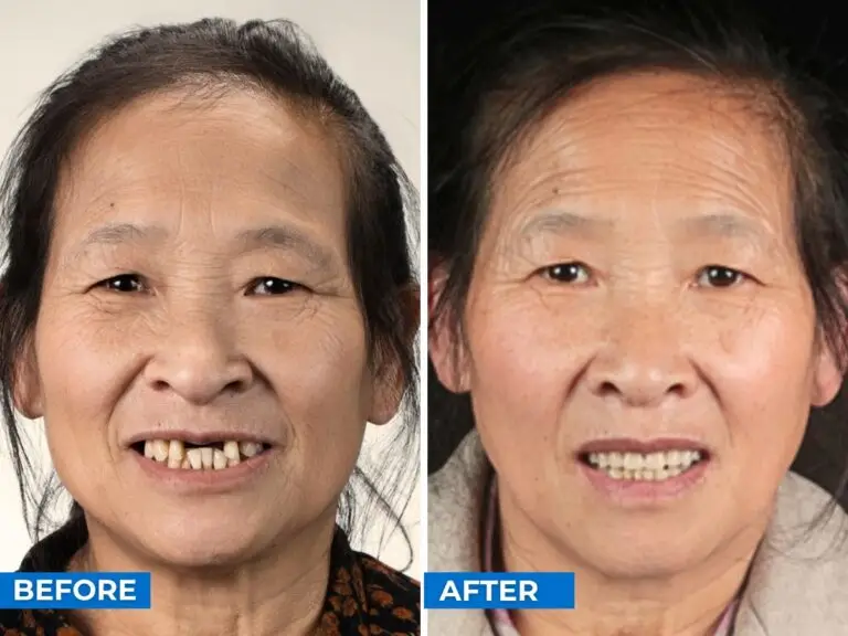 Smile 24h Beijing Patient Case of Patient Transformation 2