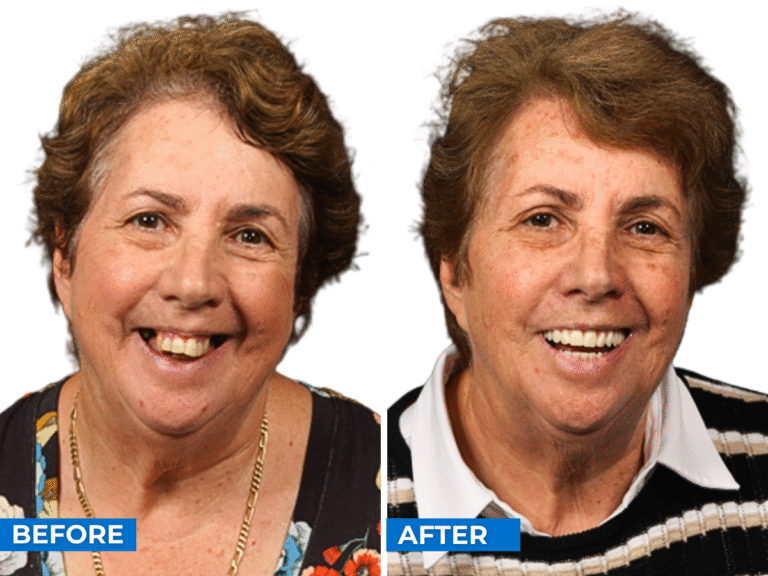 Smile 24h Victoria Patient Case of Patient Transformation 1