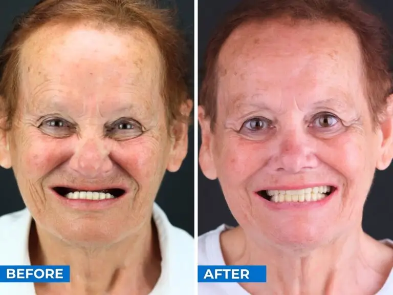 Smile 24h Paris Patient Case of Patient Transformation 1