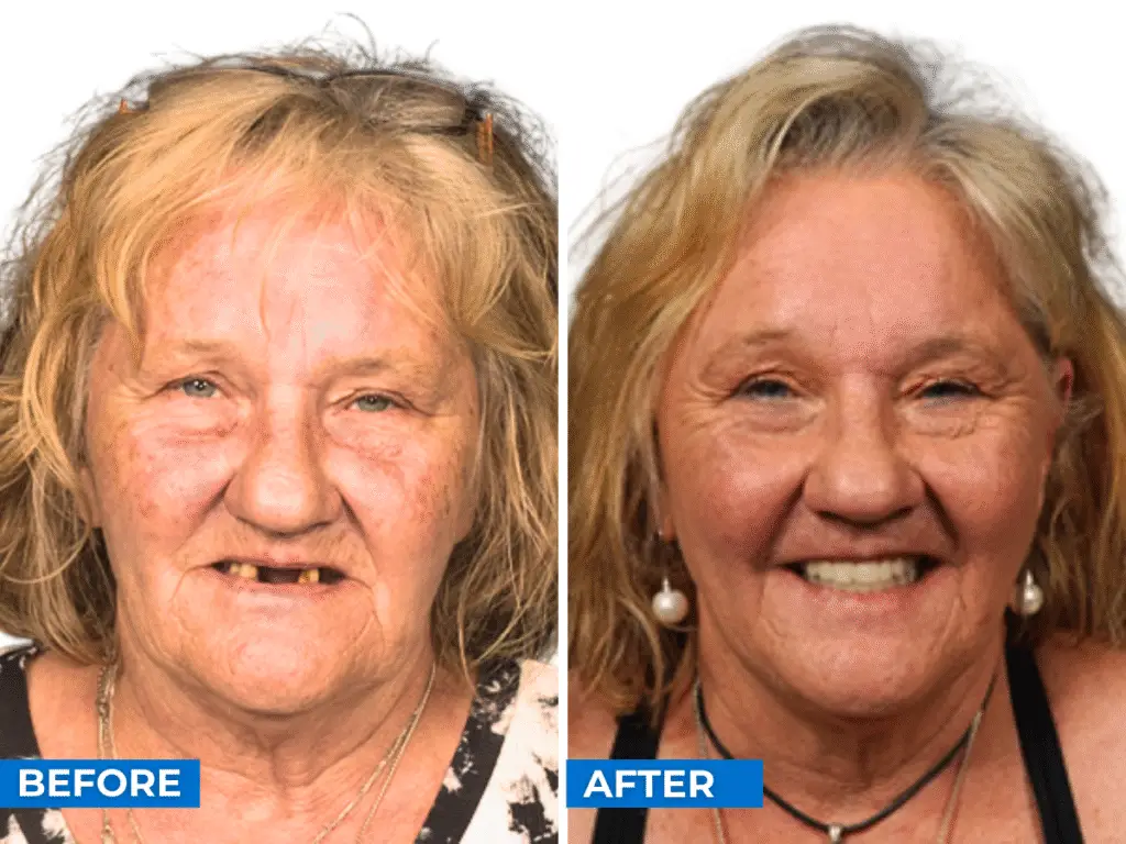 Smile 24h Melbourne Patient Case of Patient Transformation 2