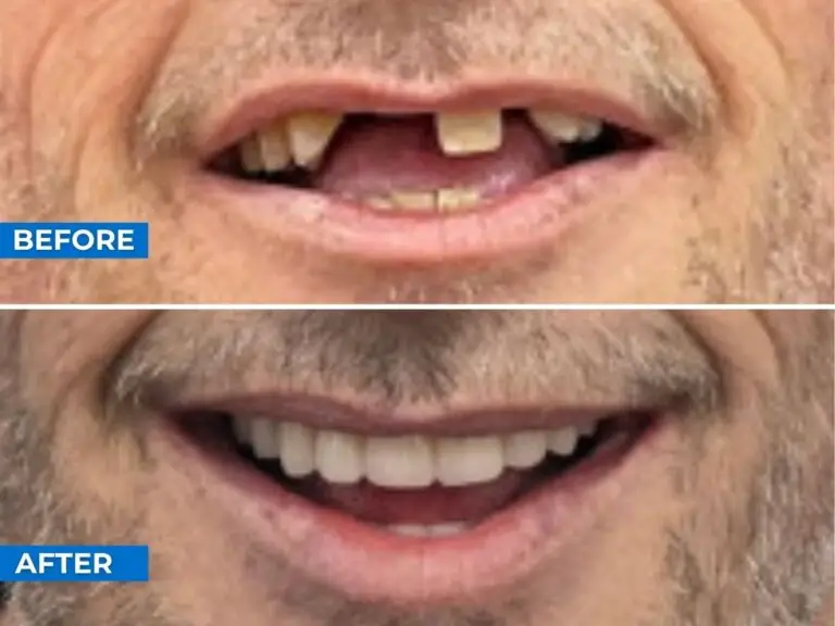Smile 24h Ho Chi Minh City Patient Case of Patient Transformation 3
