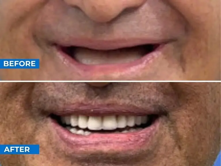 Smile 24h Ho Chi Minh City Patient Case of Patient Transformation 2