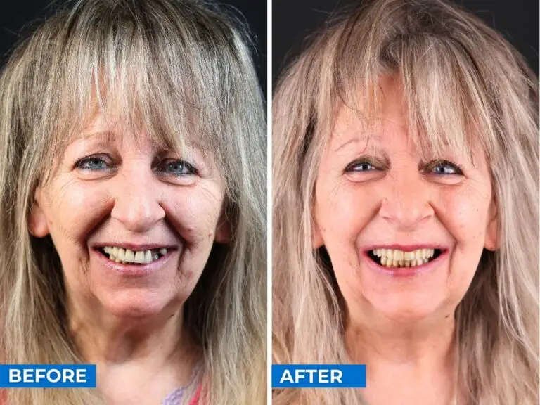 Smile 24h Paris Patient Case of Patient Transformation 3