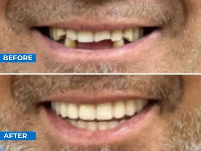 Smile 24h Ho Chi Minh City Patient Case of Patient Transformation 1