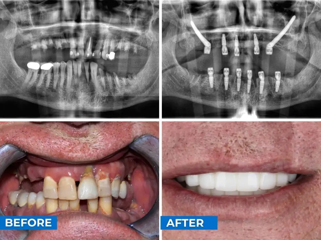 Caso de paciente de Smile 24h Cancún transformación 2