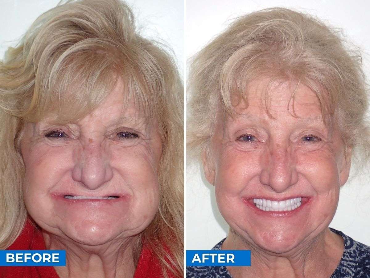 Dental Implants Personal Stories: Tammy’s Success Journey