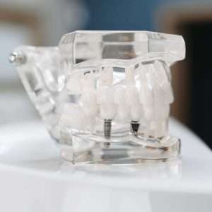 Modelo de boca para implantes dentales