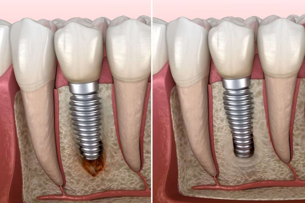 Dental Implant Osseointegration