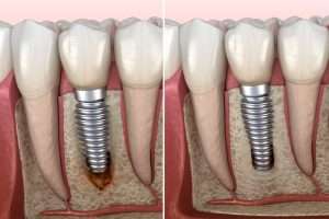 Osteointegración de implantes dentales