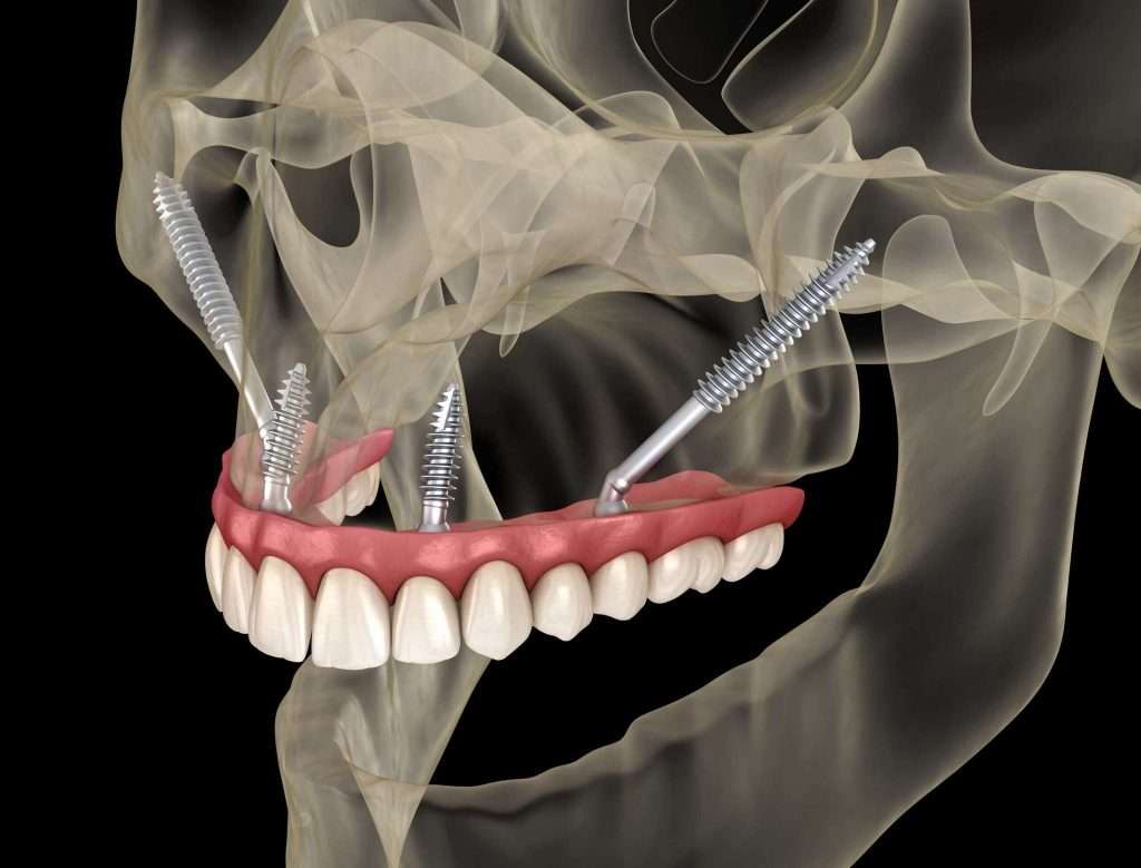 Hybrid Zygoma Rehabilitation