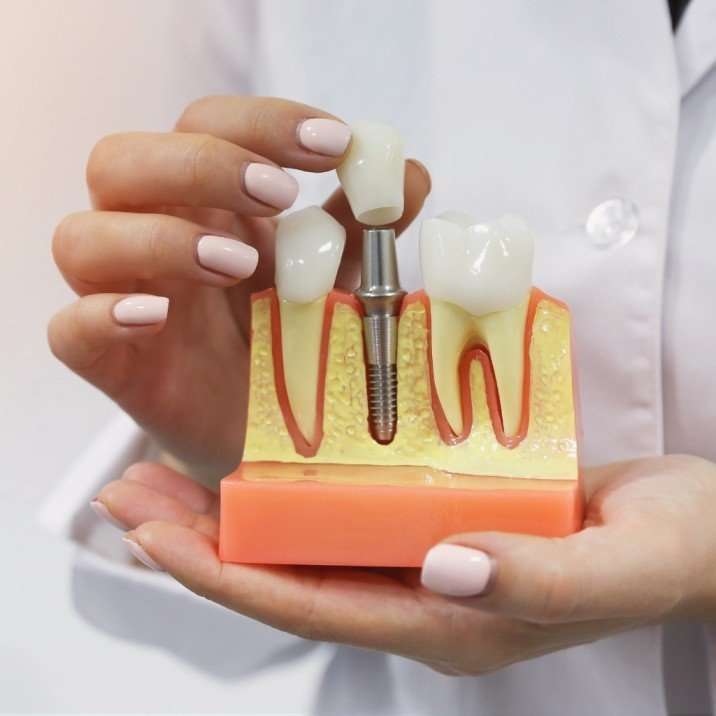 Implant Schematic Hands