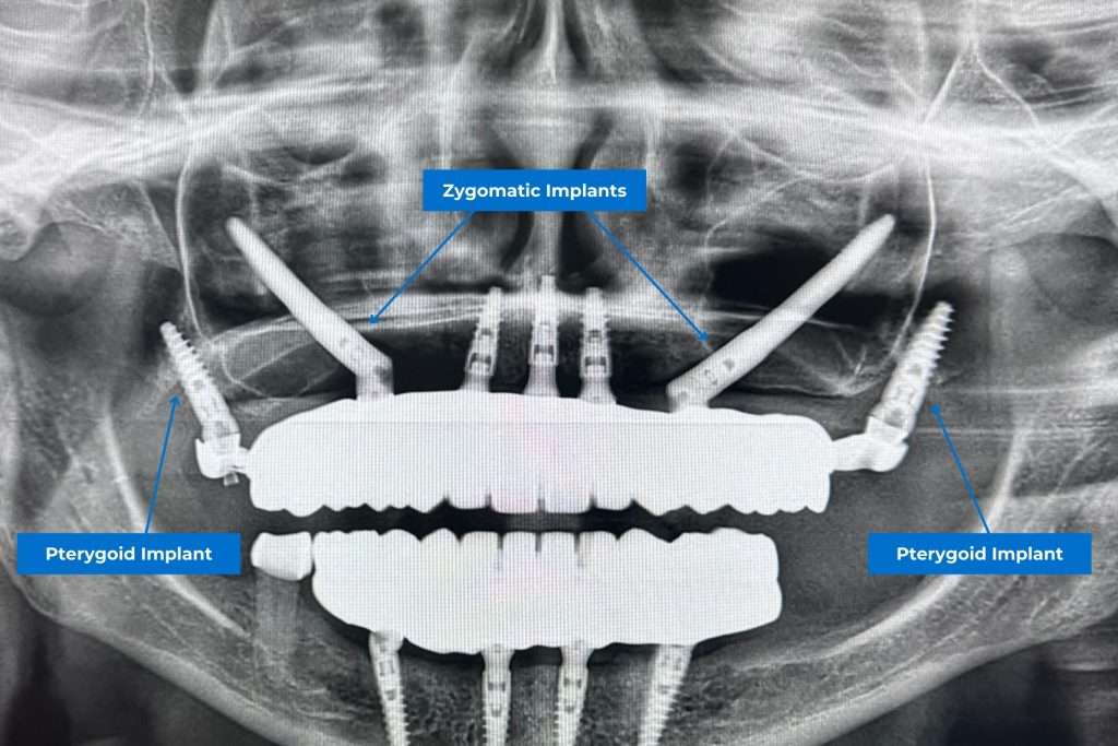 Pterygoid Implants