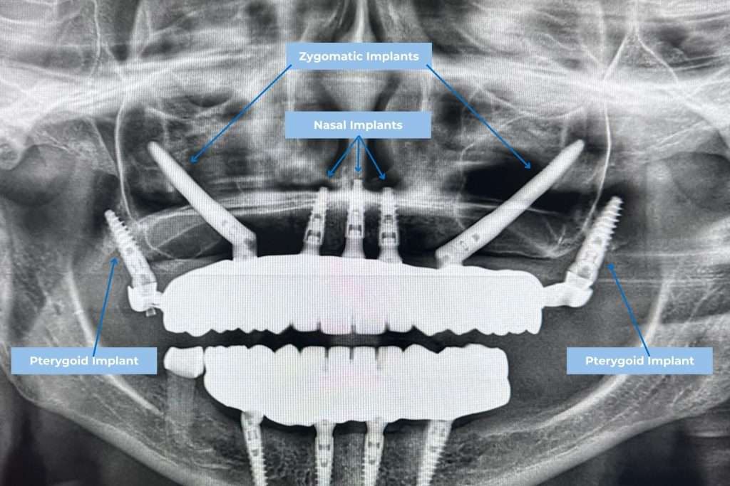 Upper jaw dental implants