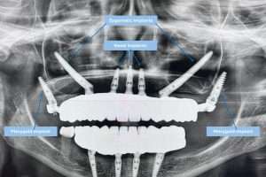 Implantes dentales maxilares