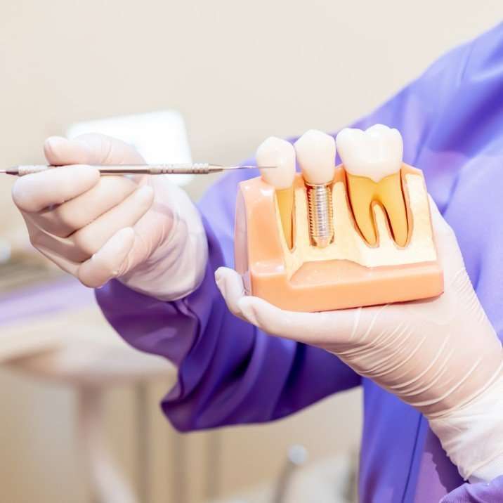 tooth replacement