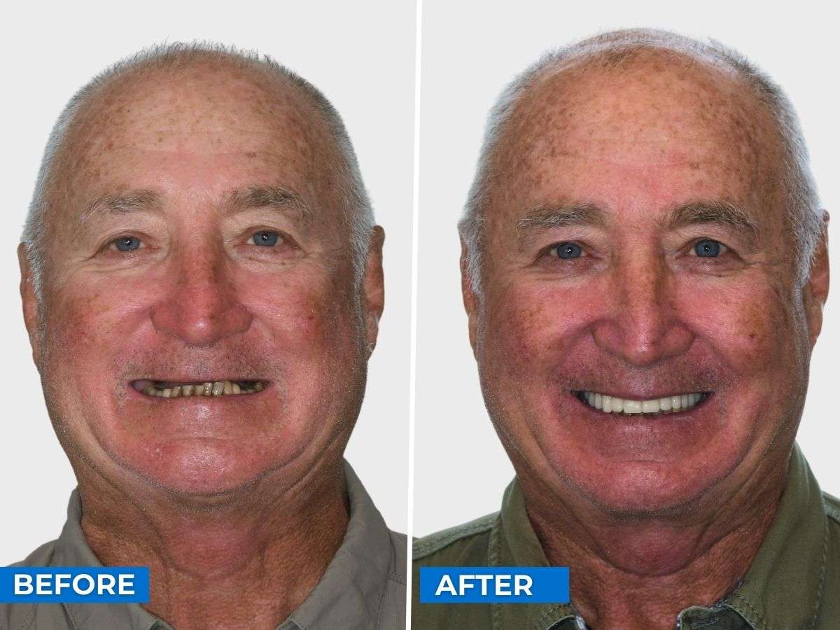 Patient stories: Bruce